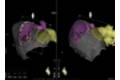 Sistema de navegación cardiaca CARTO