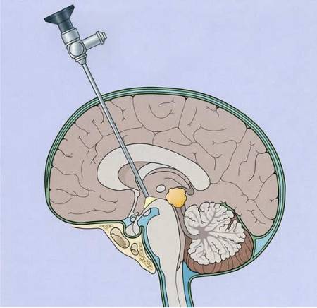 Neuroendoscopia