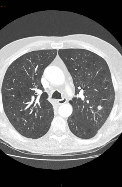 En la fotografía, nódulos pulmonares resultantes en neoplasia pulmonar precoz.